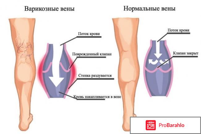 Варикоз форум обман