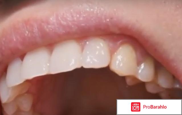 Реставрация передних зубов отрицательные отзывы