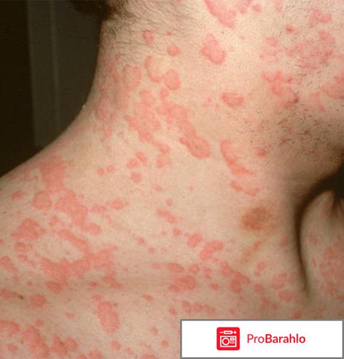 Хроническая идиопатическая крапивница — Причины 