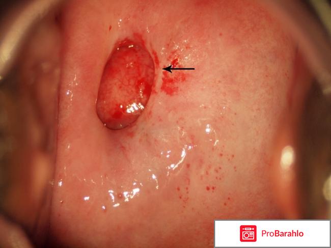 Полипэктомия матки отрицательные отзывы