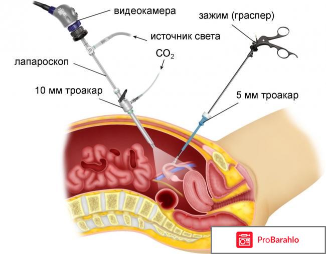 Лапароскопия отзывы 