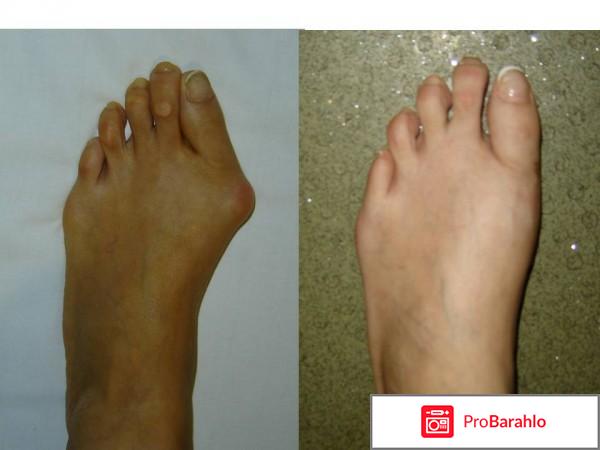 Hallux Valgus обман