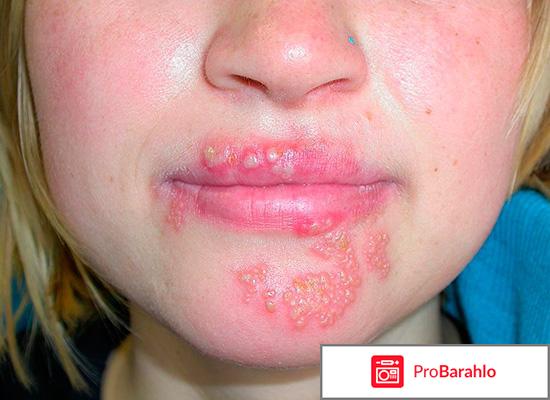 Ацикловир инструкция по применению цена отзывы отрицательные отзывы