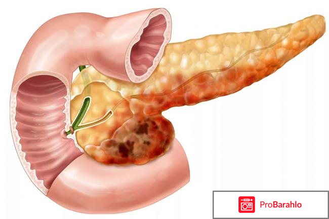 Список лекарств при панкреатите отрицательные отзывы