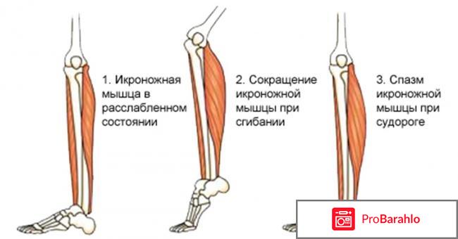 Судорога икроножной мышцы — Причины и лечение обман