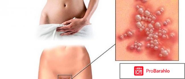 Натрия тетраборат при молочнице у женщин отзывы отрицательные отзывы