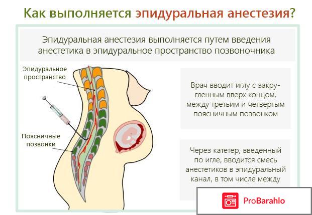 Спинальная анестезия отзывы 