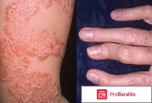 PsoriStop ( Псори Стоп ) - циничный развод-лохотрон на больных псориазом отрицательные отзывы