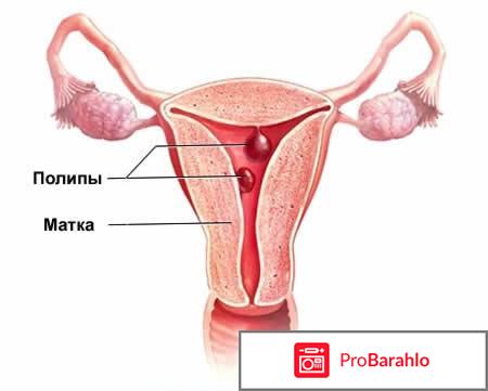 Причины возникновения полипов в матке 