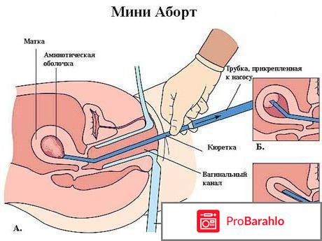 Вакуумный аборт отзывы отрицательные отзывы