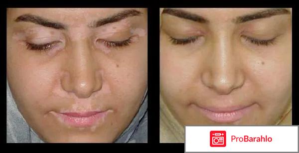 Борная кислота от витилиго отзывы обман