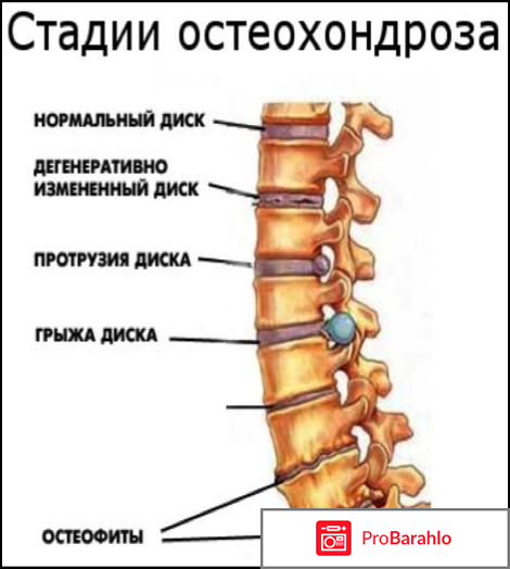 Остеохондроз пояснично крестцового отдела позвоночника 