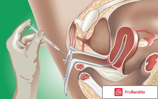 Инсеминация отзывы отрицательные отзывы
