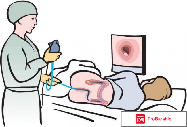 Больно ли делать колоноскопию отрицательные отзывы