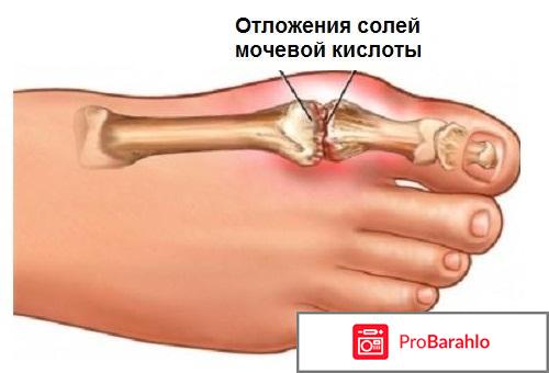 Мочевая кислота в организме обман