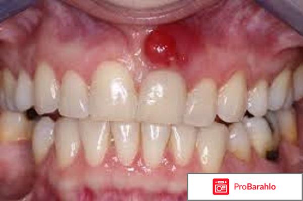 Гнойное образование на десне отрицательные отзывы