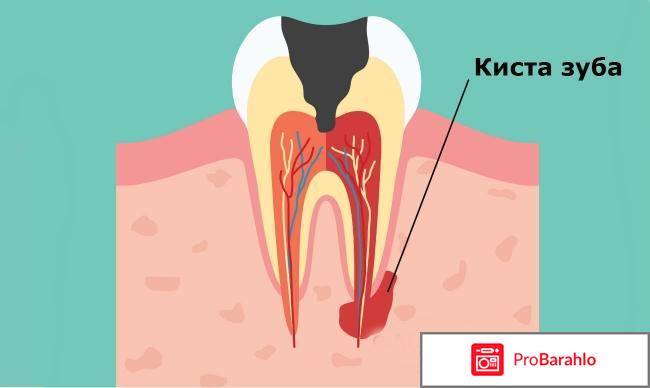 Киста зуба удаление 