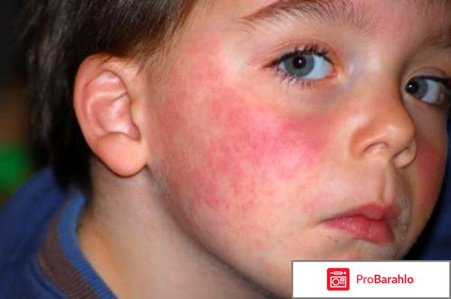 Аллергия у детей симптомы 