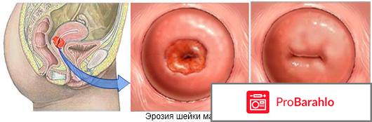 Лечение шейки матки народными средствами 