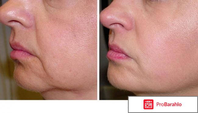 Гиалурон (Гиалуроника) 