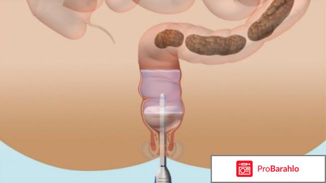 Клизма в домашних условиях обман