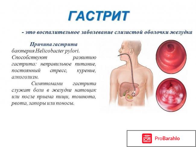 Гастрит препараты отрицательные отзывы