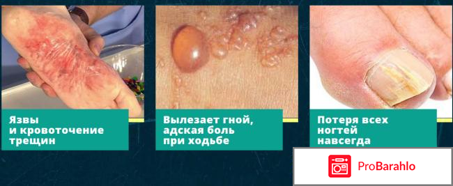 Сангридок спрей от грибка - развод или нет? фото