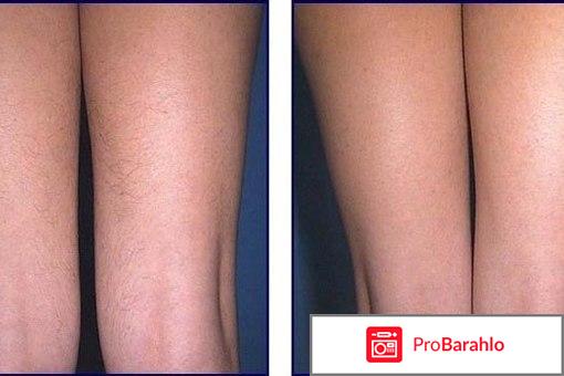 Фотоэпиляция дома обман