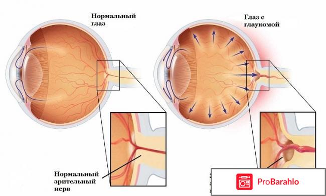 Как лечить глаукому в домашних условиях народными средствами 