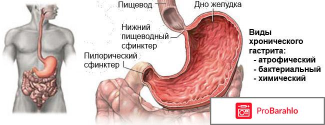 Поверхностный гастрит что это такое обман