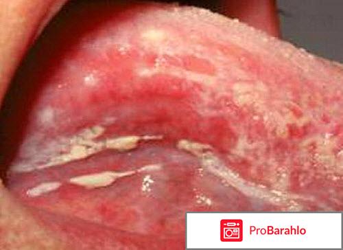 Народные средства от молочницы у женщин отзывы отрицательные отзывы