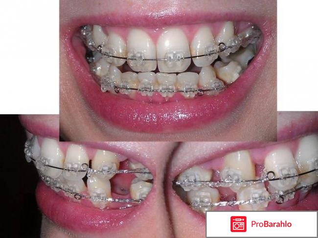 Как исправить кривые зубы 