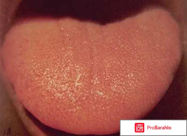 Язык шершавый: причины 