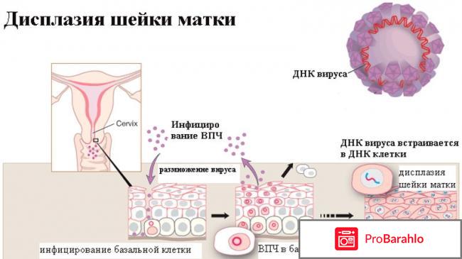 Вирус папилломы человека у женщин в гинекологии отрицательные отзывы