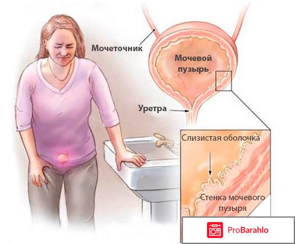 Монурал побочные действия отрицательные отзывы