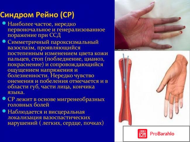 Синдром Рейно: причины, стадии, симптомы, лечение отрицательные отзывы