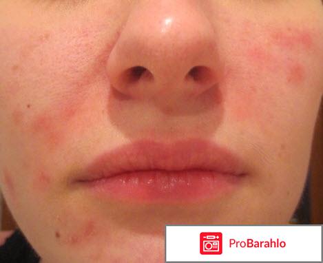 Пятна на теле реальные отзывы