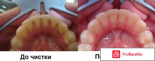 Отбеливание методом air flow отрицательные отзывы