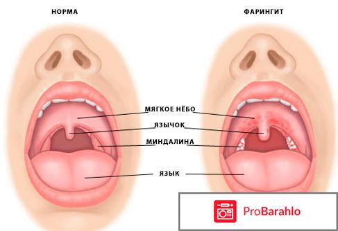 Хронический фарингит симптомы 