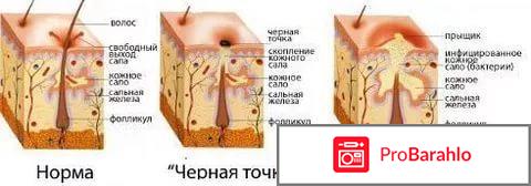 Избавление от прыщей на спине отрицательные отзывы