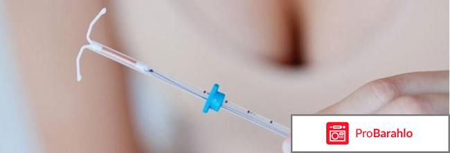 Вмс мирена цена отрицательные отзывы