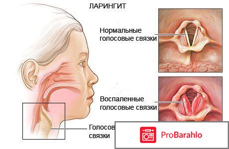 Ларингит чем лечить 