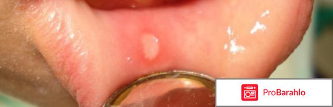 Стоматит: лечение у взрослых, фото, чем и как лечить обман