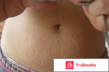 Бепантен от растяжек обман