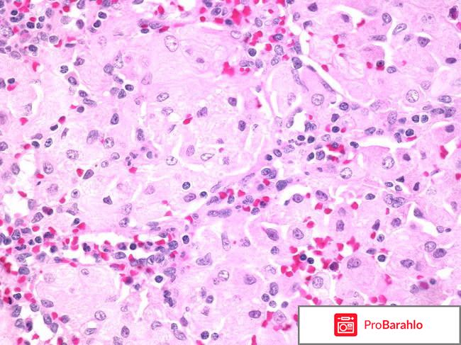 Болезнь гоше обман