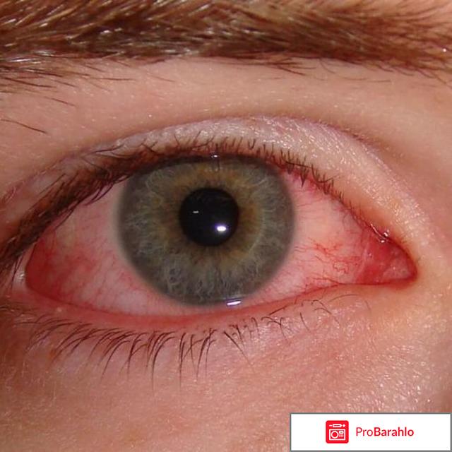 Лечение коньюктивита в домашних условиях у взрослых 