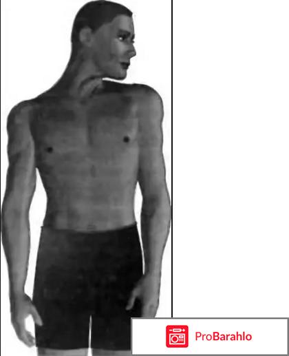 Кривошея у взрослых отрицательные отзывы