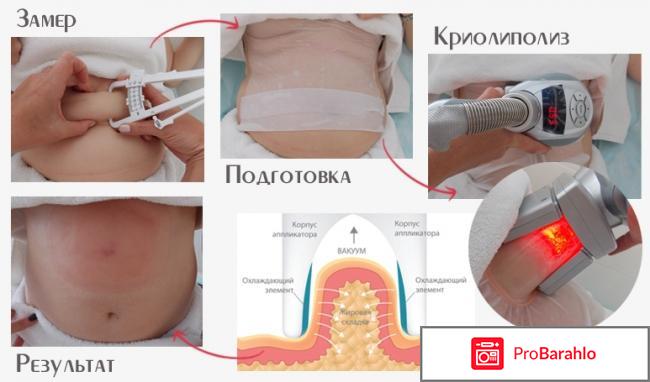 Криолиполиз отзывы врачей противопоказания 