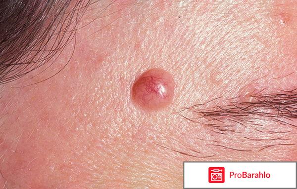 Папинол отзывы реальные 