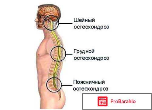 Как лечить остеохондроз отрицательные отзывы